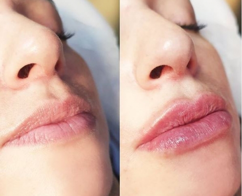 aumento de labios madrid