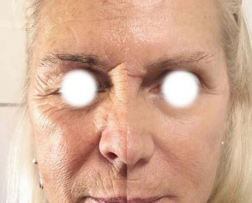 lifting facial plexr pro