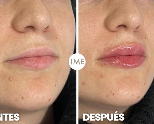 antes y después aumento de aumento