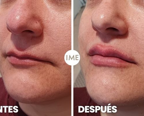 antes y después aumento de aumento