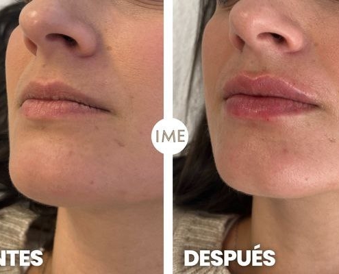 antes y después aumento de aumento