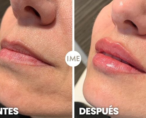 antes y después aumento de aumento