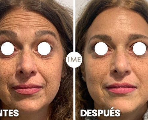antes y después eliminar arrugas