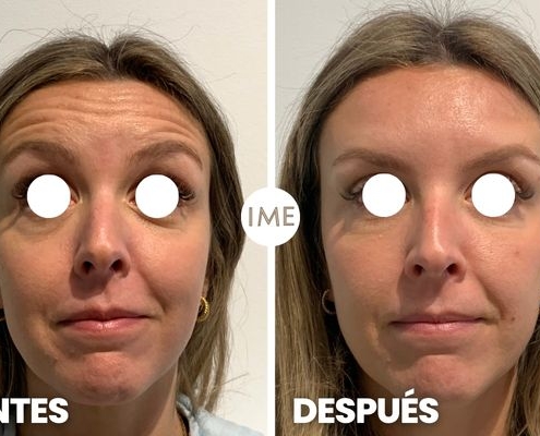 antes y después eliminar arrugas