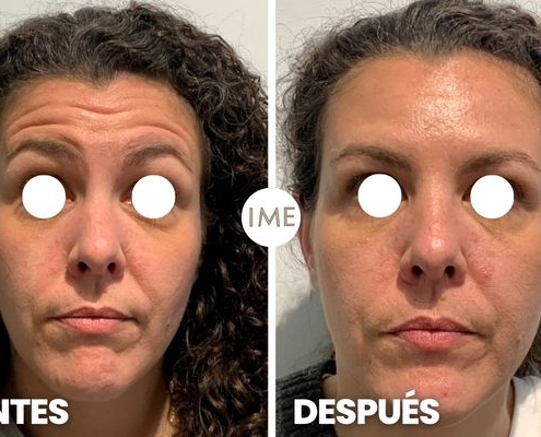 antes y después eliminar arrugas