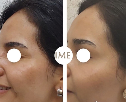 Antes y Después Patas de Gallo