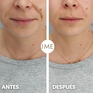 antes y despues surco nasogeniano